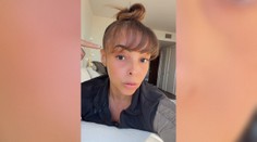 Vedľajší účinok šokoval aj lekára. Po transplantácii vlasov žena spozorovala nečakaný problém