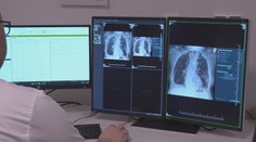 Odhalí aj to, čo by mohlo ľudskému oku ujsť. V Michalovciach pomáha s vyhodnotením röntgenov umelá inteligencia