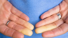 Menia vám ruky v zime farbu? Radšej to neignorujte