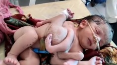 V Indii sa narodilo dievčatko so štyrmi nohami a tromi rukami. Pôvodne malo ísť o dvojičky