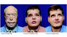 Plamene hasičovi znetvorili tvár, po 15 rokoch sa už môže usmievať