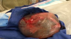 Zázrak. Dieťa sa narodilo v plodovom vaku