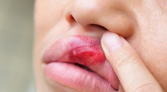 Prvá pomoc pri herpese. Pomôže vám jedna prírodná látka