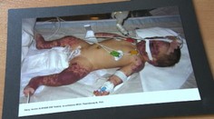 Vražedné osýpky, mumps či čierny kašeľ. Strašiaci minulosti sú späť