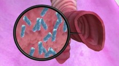 Ochorenie, na ktoré sa zomieralo, je späť. Slovensko hlási nové prípady čierneho kašľa