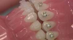 Dajte si pozor, kto vám robí zubný strojček. Pre peniaze to robia aj lekári, ktorí na to nemajú vzdelanie