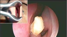 Mladík roky krvácal z nosa. Príčina ho šokovala