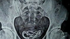 Muž prehltol nabíjačku na mobil. Keď lekár zistil, kam sa až dostala, zostal v šoku