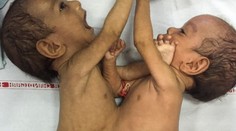 Úspešne oddelili siamské dvojčatá. Takéto sú z nich krásne bábätka