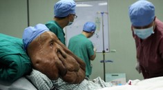 FOTO: Tvár mu znetvoril obrovský nádor