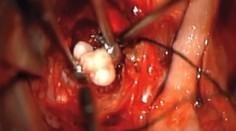 Zuby v nádore? Lekári ich našlii u štvormesačného bábätka