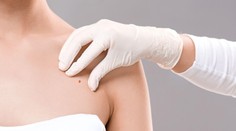 Zanedbávate kontroly u kožného lekára? Rakovina sa môže objaviť aj na miestach, na ktoré zabúdame