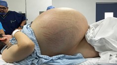 Žene odstránili nádor ťažký ako 10-ročné dieťa. Zverejnili jeho fotku