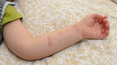 Popáleniny sú u detí horšie ako u dospelých