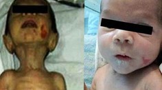 Šokujúce FOTO! Lekári zachránili týrané bábätko v otrasnom stave