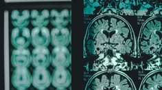 Prielom v liečbe Alzheimera? Nová vakcína dokáže ochorenie spomaliť, ale aj zneškodniť