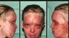 Takto vyzerala po útoku kyselinou. Dnes je nádherná a zasnúbená