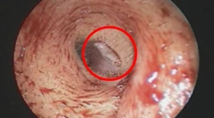 Nechutné: Žene žila v uchu larva muchy. Nakrútili ju na video