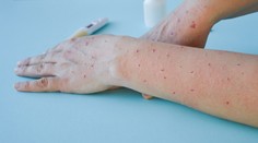 Čech, ktorý sa nakazil opičími kiahňami, opísal, aké príznaky ochorenia sa uňho prejavili