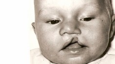 Novinári otvárajú staré rany: Tehotenský test zabíjal a spôsoboval postihnutie