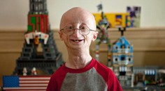 Zomrel chlapec, ktorý vyzeral ako starec