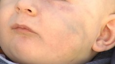 V prípade dohryzeného jasličkára padlo obvinenie. Odtlačok učiteľkinho chrupu rozhodol