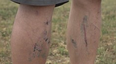 Ďalší stret medveďa s človekom. Hubár opísal, ako so šelmou bojoval o holý život