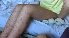 Dievča (13) hospitalizovali s vyrážkami. V tomto prípade nejde o Kawasakiho chorobu