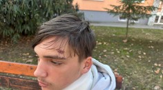 Tomáš (18) opísal brutálny útok teleskopickou tyčou. Motívom nebola žiarlivosť, tvrdí