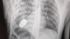 Riskantná operácia. Ukrajinskí chirurgovia vyoperovali z hrude vojaka nevybuchnutý granát