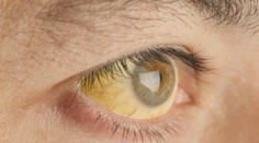 V strehu sú hygienici, lekári aj školy. Žltačka sa začína šíriť aj v ďalšom regióne Slovenska