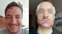 Študent si vzal život po tom, čo mu v Turecku transplantoval bradu realitný maklér vydávajúci sa za chirurga