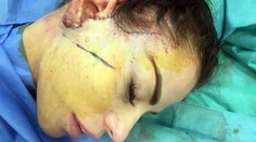 Len pre silné žalúdky! Modelka zverejnila zábery z kozmetického zákroku