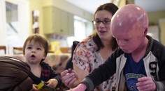 Chlapček trpí unikátnou chorobou. Abnormálne rýchlo mu rastie koža