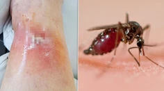 Obyčajný štípanec sa zmenil na nočnú moru. Slovenka mala o pár dní na nohe otvorenú ranu
