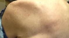 Muž (†66) zomrel po nakazení baktériou, tú istú dostal na dovolenke v Bulharsku aj Čech