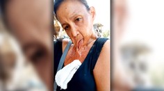 Požiar jej spôsobil hororové zranenie. Žene po rokoch utrpenia svitá nádej na normálny život