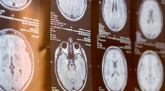 Pri mozgovej príhode rozhodujú minúty. Neurochirurg opísal príznaky, ktoré netreba ignorovať