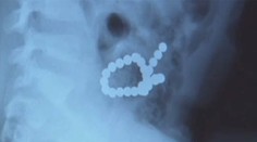 Chlapček (5) si pomýlil magnetky na chladničke s cukríkmi, zjedol ich rovno 30