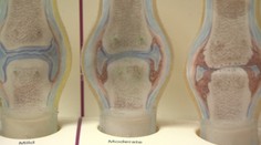 Reuma postihuje aj mladých ľudí. Ak máte tieto príznaky, treba spozornieť