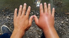 Alergikom svitá na lepšie časy. Utrpenia ich zbaví liečba, ktorá je dostupná už aj na Slovensku