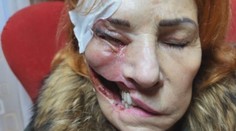 Oľge z Handlovej už dva roky požiera tvár parazit. Lekári nevedia zistiť, o čo ide, a tak trpí v bolestiach