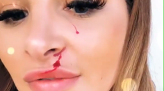 Čo sa jej stalo? Zuzana Plačková ukázala zakrvavenú tvár