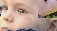 Adamko sa vrátil z jaslí dohryzený: Posudok ukázal, komu zrejme patria odtlačky zubov