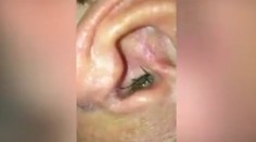 Video, z ktorého behá mráz po chrbte. Z mužovho ucha vyliezlo malé zvieratko