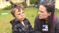 "Jedol ma!" Takto opísal chlapec (4) útok pitbulom