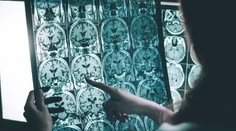 Nádej pre nespočetné množstvo ľudí. Lekári našli nový spôsob včasného odhalenia Alzheimera