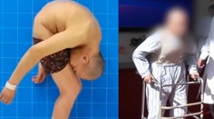 Lekári ukončili trápenie muža, ktorý prežil väčšinu života v krkolomnej polohe