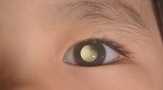 Dievčatko malo na fotke zvláštny odlesk v oku. Lekári jej diagnostikovali vzácnu chorobu