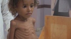 Vo vojnovom Jemene nezabíjajú len zbrane, ale hlad. K deťom sa lekár nedostane vždy včas